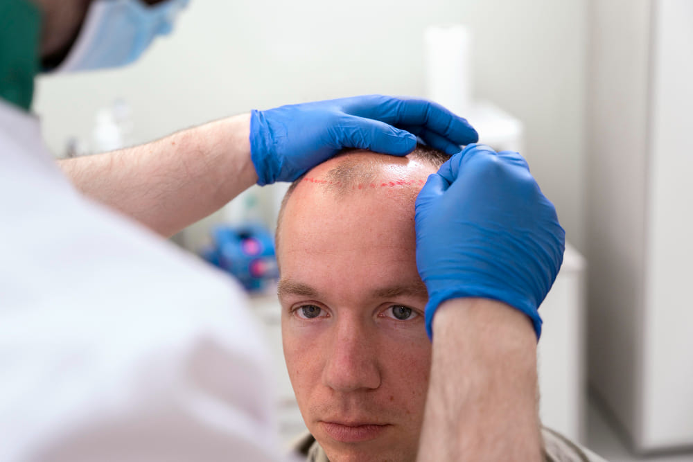 PRP Hair Therapy